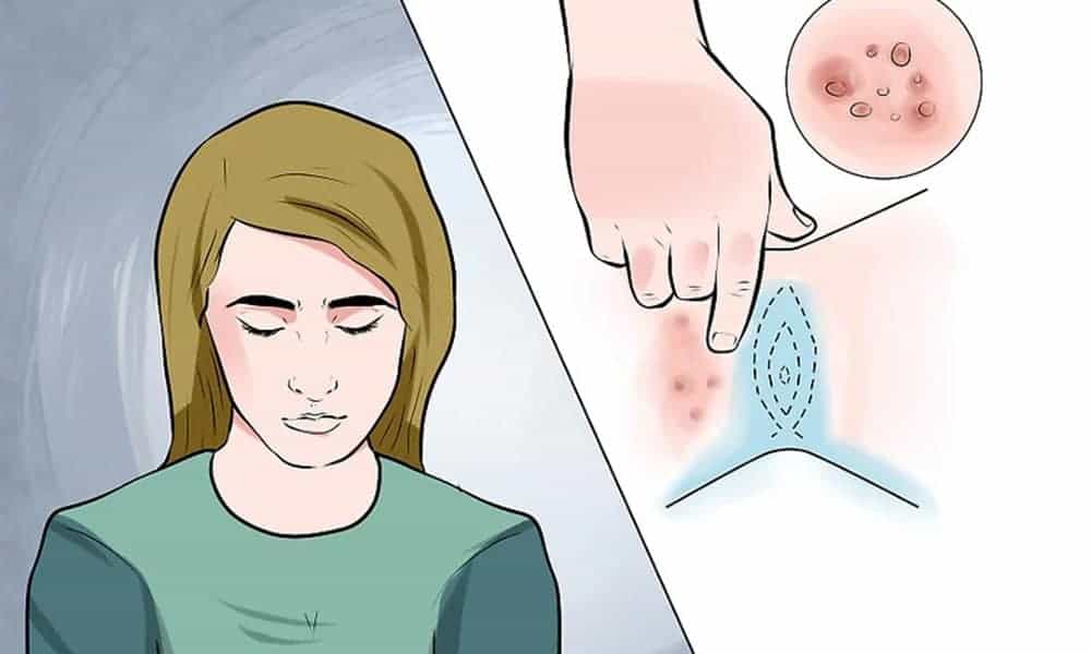 درمان زگیل تناسلی با قرص پاورفیت در چه شرایطی صورت می گیرد؟